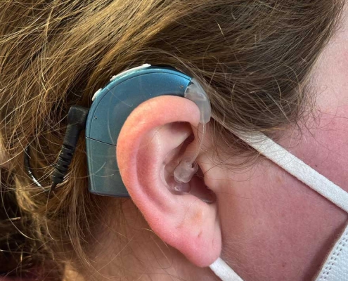 Sport machen mit Cochlea Implantaten